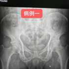 骨盆平片易漏诊骨折两例
