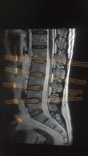 ge mri腰椎拍片定位线
