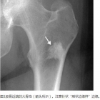 骨局灶性硬化性病变的鉴别Focal Sclerotic Lesion