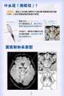 燕尾征对帕金森病的诊断意义