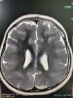 巨脑回畸形（Pachygyria）MRI病例